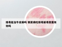 排毒能治牛皮癣吗 银屑病吃排毒解毒胶囊有效吗