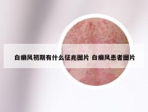 白癞风初期有什么征兆图片 白癞风患者图片