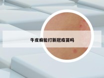 牛皮癣能打新冠疫苗吗