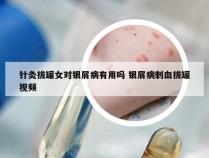 针灸拔罐女对银屑病有用吗 银屑病刺血拔罐视频