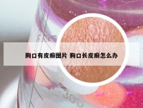 胸口有皮癣图片 胸口长皮癣怎么办