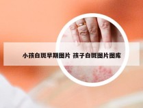 小孩白斑早期图片 孩子白斑图片图库