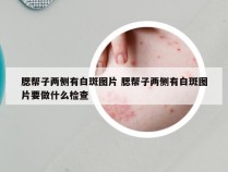 腮帮子两侧有白斑图片 腮帮子两侧有白斑图片要做什么检查