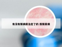 有没有银病屑治愈了的 我银屑病