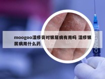 moogoo湿疹膏对银屑病有用吗 湿疹银屑病用什么药