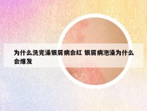 为什么洗完澡银屑病会红 银屑病泡澡为什么会爆发