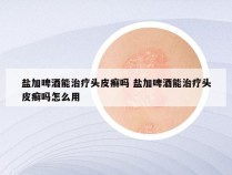 盐加啤酒能治疗头皮癣吗 盐加啤酒能治疗头皮癣吗怎么用