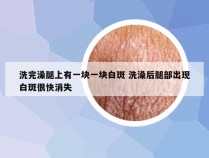 洗完澡腿上有一块一块白斑 洗澡后腿部出现白斑很快消失