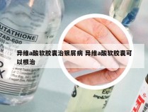 异维a酸软胶囊治银屑病 异维a酸软胶囊可以根治