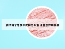 孩子得了急性牛皮癣怎么治 儿童急性银屑病