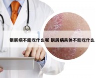 银屑病不能吃什么呢 银屑病具体不能吃什么