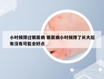 小时候得过银屑病 银屑病小时候得了长大后有没有可能会好点