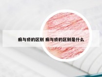 癣与疥的区别 癣与疥的区别是什么