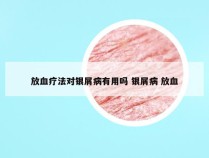 放血疗法对银屑病有用吗 银屑病 放血