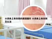 小孩身上有白斑的原因图片 小孩身上有白斑怎么治