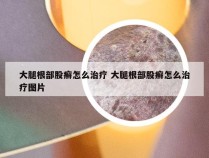 大腿根部股癣怎么治疗 大腿根部股癣怎么治疗图片