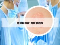 圆斑癣症状 圆斑病病症