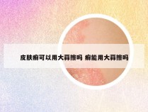 皮肤癣可以用大蒜擦吗 癣能用大蒜擦吗