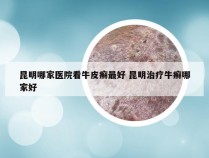 昆明哪家医院看牛皮癣最好 昆明治疗牛癣哪家好