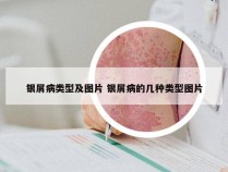 银屑病类型及图片 银屑病的几种类型图片