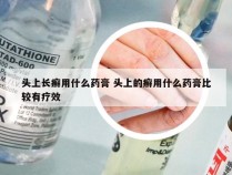 头上长癣用什么药膏 头上的癣用什么药膏比较有疗效