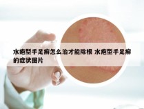 水疱型手足癣怎么治才能除根 水疱型手足癣的症状图片