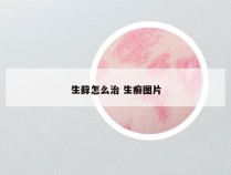 生藓怎么治 生癣图片