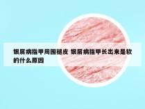 银屑病指甲周围褪皮 银屑病指甲长出来是软的什么原因