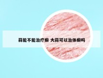 蒜能不能治疗癣 大蒜可以治体癣吗