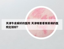 天津牛皮癣好的医院 天津哪里看银屑病的医院比较好?