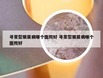 寻常型银屑病哪个医院好 寻常型银屑病哪个医院好