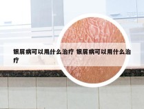 银屑病可以用什么治疗 银屑病可以用什么治疗