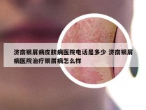 济南银屑病皮肤病医院电话是多少 济南银屑病医院治疗银屑病怎么样