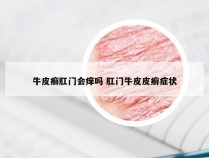 牛皮癣肛门会痒吗 肛门牛皮皮癣症状