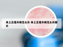 身上总是长癣怎么办 身上总是长癣怎么办图片