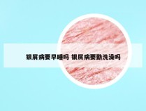 银屑病要早睡吗 银屑病要勤洗澡吗