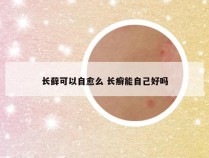 长藓可以自愈么 长癣能自己好吗