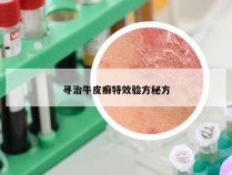 寻治牛皮癣特效验方秘方