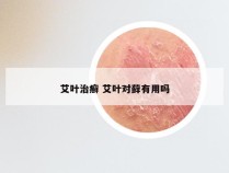 艾叶治癣 艾叶对藓有用吗