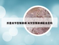 折叠关节型银屑病 关节型银屑病能自愈吗