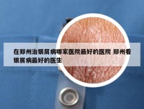 在郑州治银屑病哪家医院最好的医院 郑州看银屑病最好的医生