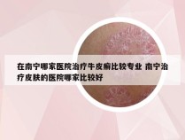 在南宁哪家医院治疗牛皮癣比较专业 南宁治疗皮肤的医院哪家比较好