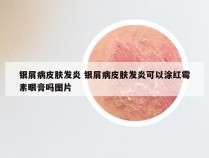 银屑病皮肤发炎 银屑病皮肤发炎可以涂红霉素眼膏吗图片