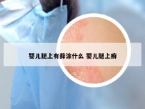 婴儿腿上有藓涂什么 婴儿腿上癣