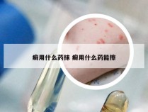 癣用什么药抹 癣用什么药能擦