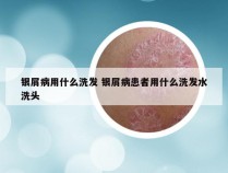 银屑病用什么洗发 银屑病患者用什么洗发水洗头