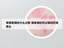 有银屑病吃什么过敏 银屑病吃抗过敏的药有用么