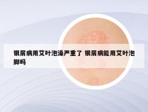 银屑病用艾叶泡澡严重了 银屑病能用艾叶泡脚吗