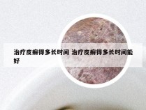 治疗皮癣得多长时间 治疗皮癣得多长时间能好