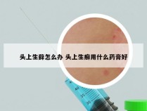 头上生藓怎么办 头上生癣用什么药膏好